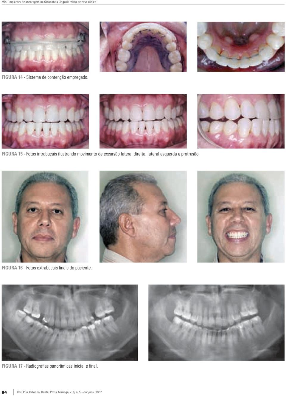 FiGurA 15 - Fotos intrabucais ilustrando movimento de excursão lateral direita,