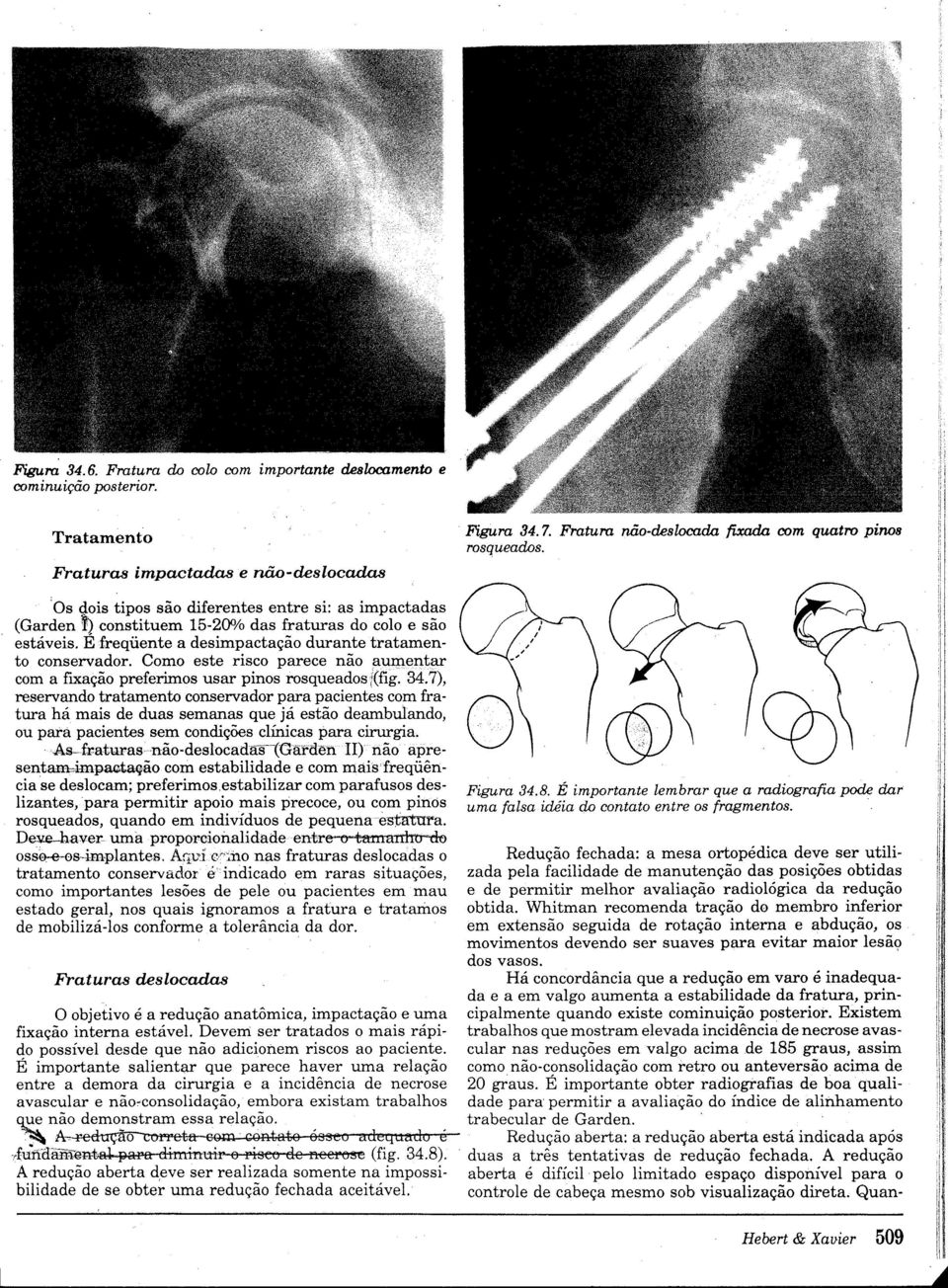 É freqüente a desimpactação durante tratamento conservador. Como este risco parece não aumentar com a fxação preferimos usar pinos rosqueados{(fg. 34.