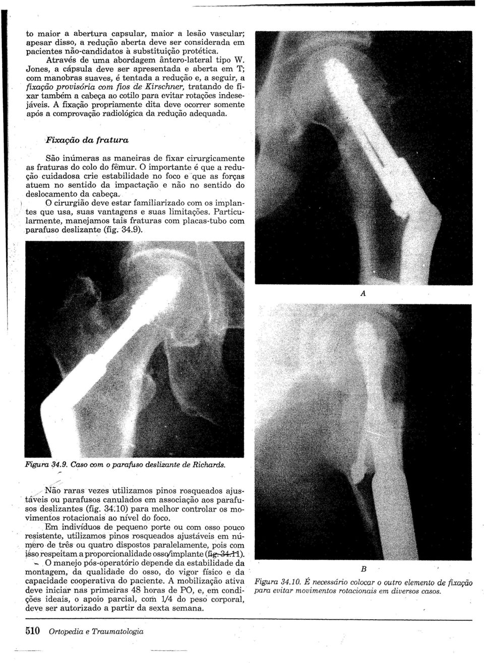 Jones, a cápsula deve ser apresentada e aberta em T; com manobras suaves, é tentada a redução e, a seguir, a fixação provisória com fios de Kirschner, tratando de fixar também a cabeça ao cotilo para