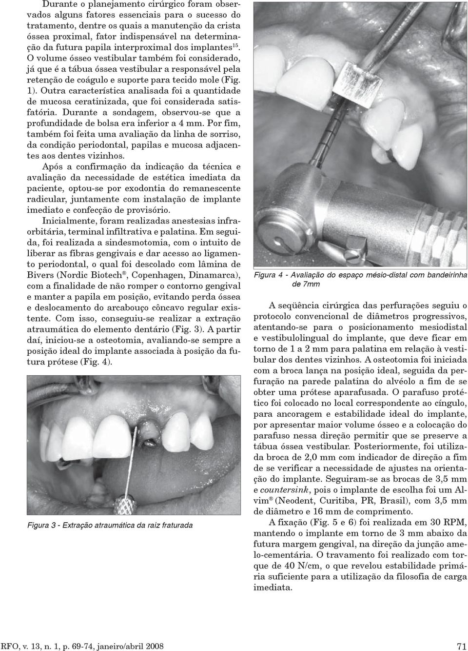 O volume ósseo vestibular também foi considerado, já que é a tábua óssea vestibular a responsável pela retenção de coágulo e suporte para tecido mole (Fig. 1).
