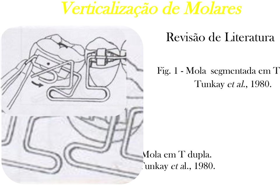 2 - Mola em T dupla. Tunkay et al., 1980.!!