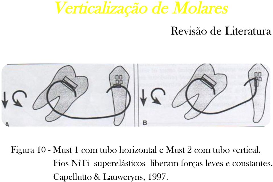 Fios NiTi superelásticos liberam forças