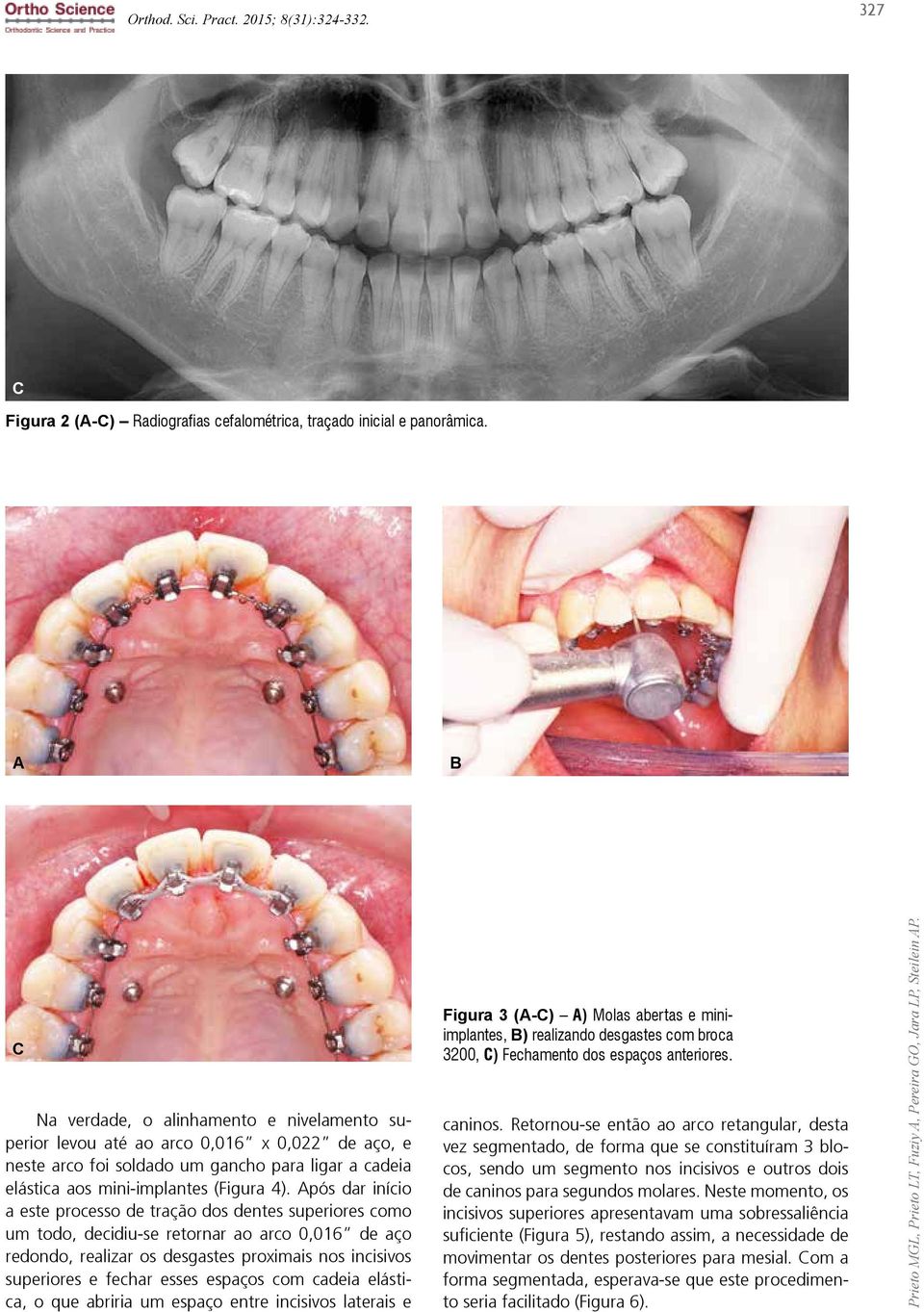 Após dr início este processo de trção dos dentes superiores como um todo, decidiu-se retornr o rco 0,016 de ço redondo, relizr os desgstes proximis nos incisivos superiores e fechr esses espços com