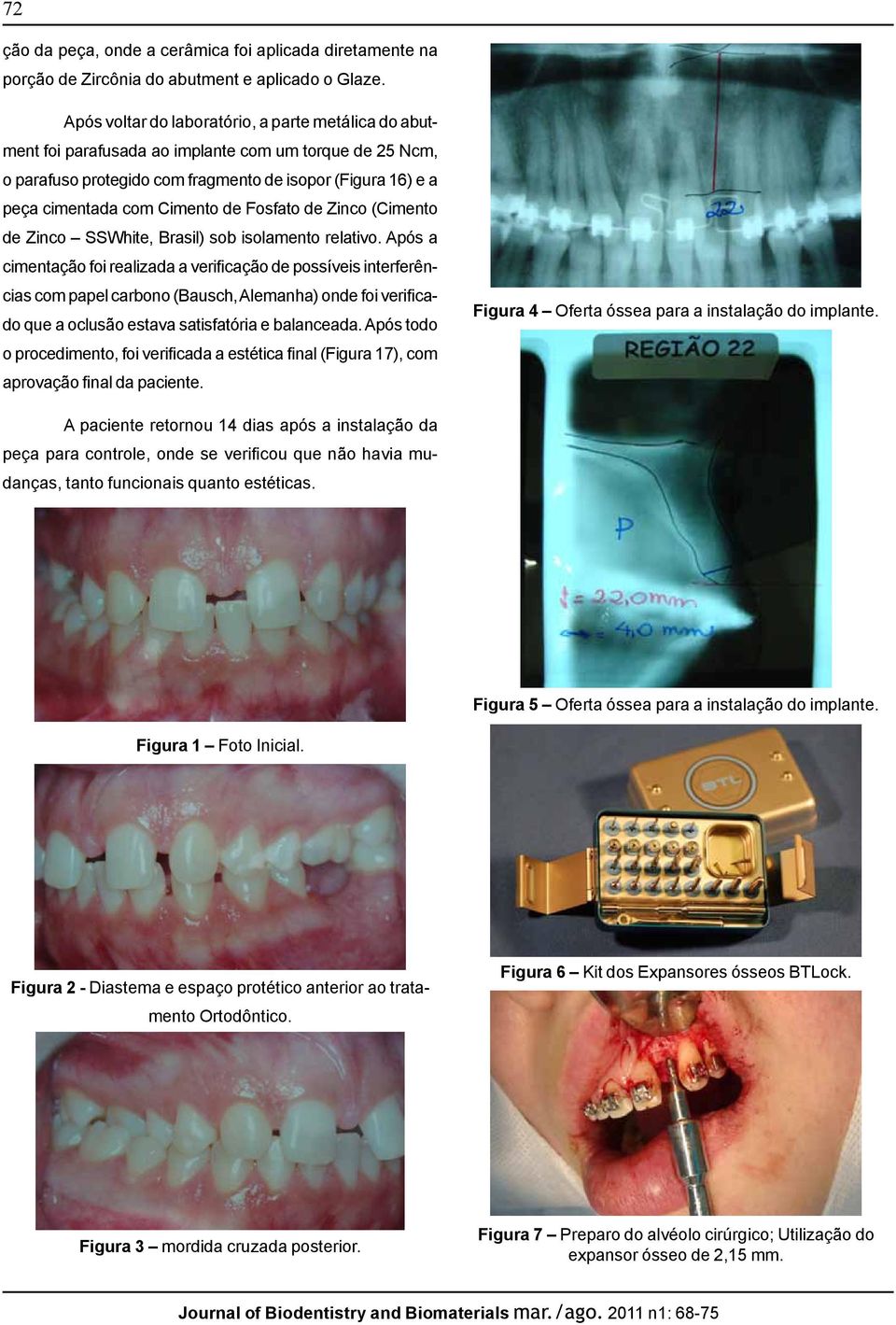 Fosfato de Zinco (Cimento de Zinco SSWhite, Brasil) sob isolamento relativo.