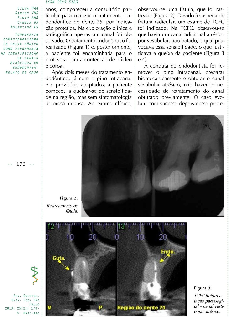 Após dois meses do tratamento endodôntico, já com o pino intracanal e o provisório adaptados, a paciente começou a queixar-se de sensibilidade na região, mas sem sintomatologia dolorosa intensa.