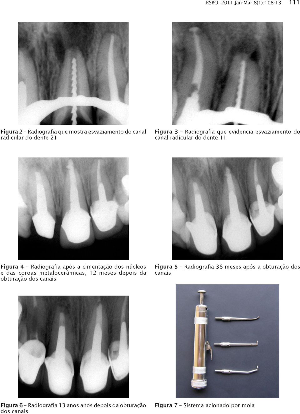 cimentação dos núcleos e das coroas metalocerâmicas, 12 meses depois da obturação dos canais Figura 5 Radiografia 36