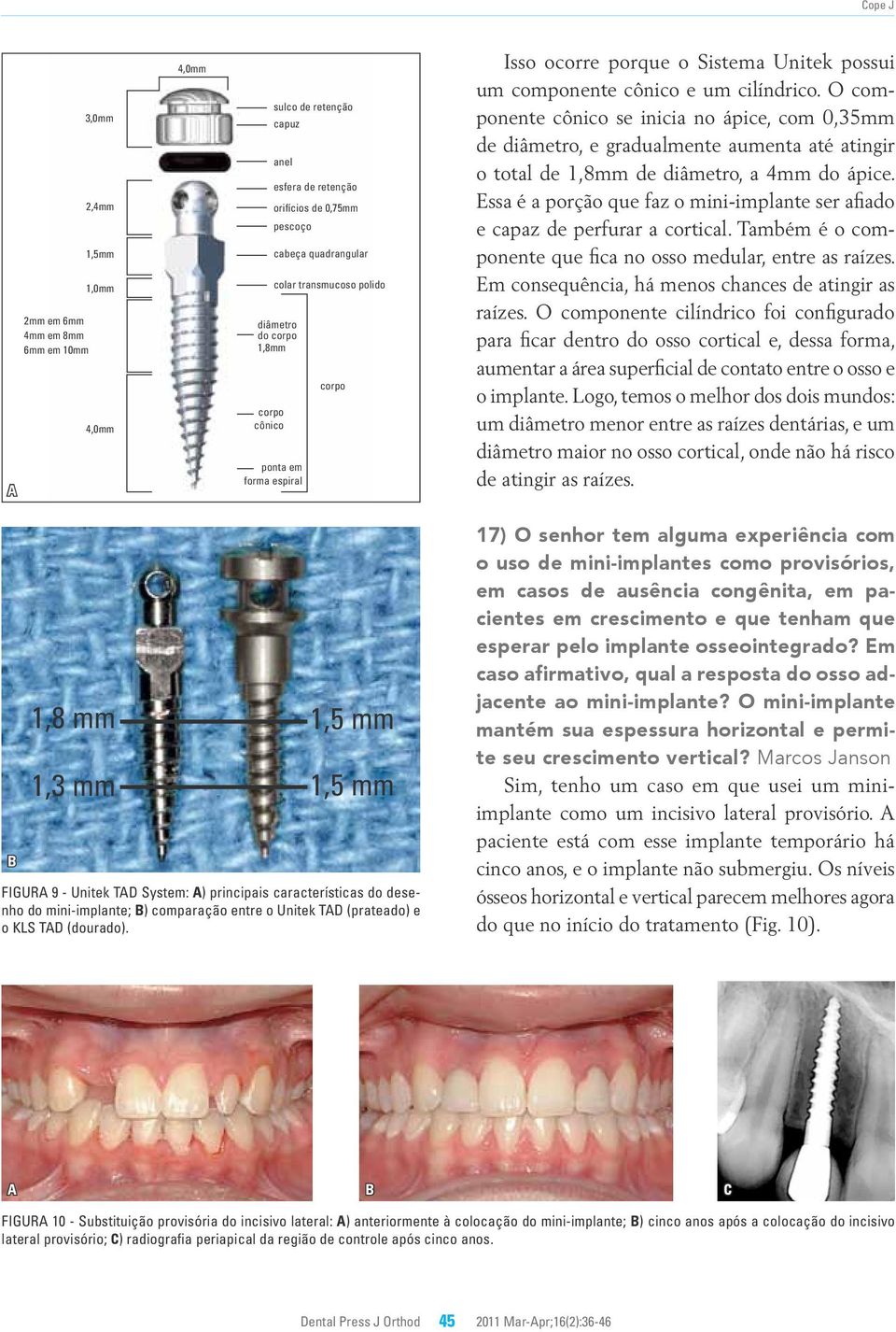 O componente cônico se inicia no ápice, com 0,35mm de diâmetro, e gradualmente aumenta até atingir o total de 1,8mm de diâmetro, a 4mm do ápice.