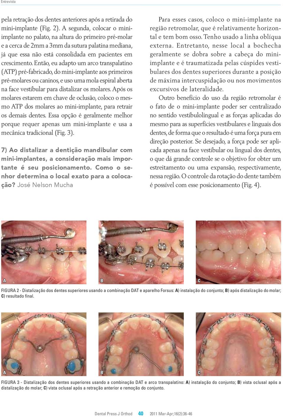 Então, eu adapto um arco transpalatino (TP) pré-fabricado, do mini-implante aos primeiros pré-molares ou caninos, e uso uma mola espiral aberta na face vestibular para distalizar os molares.