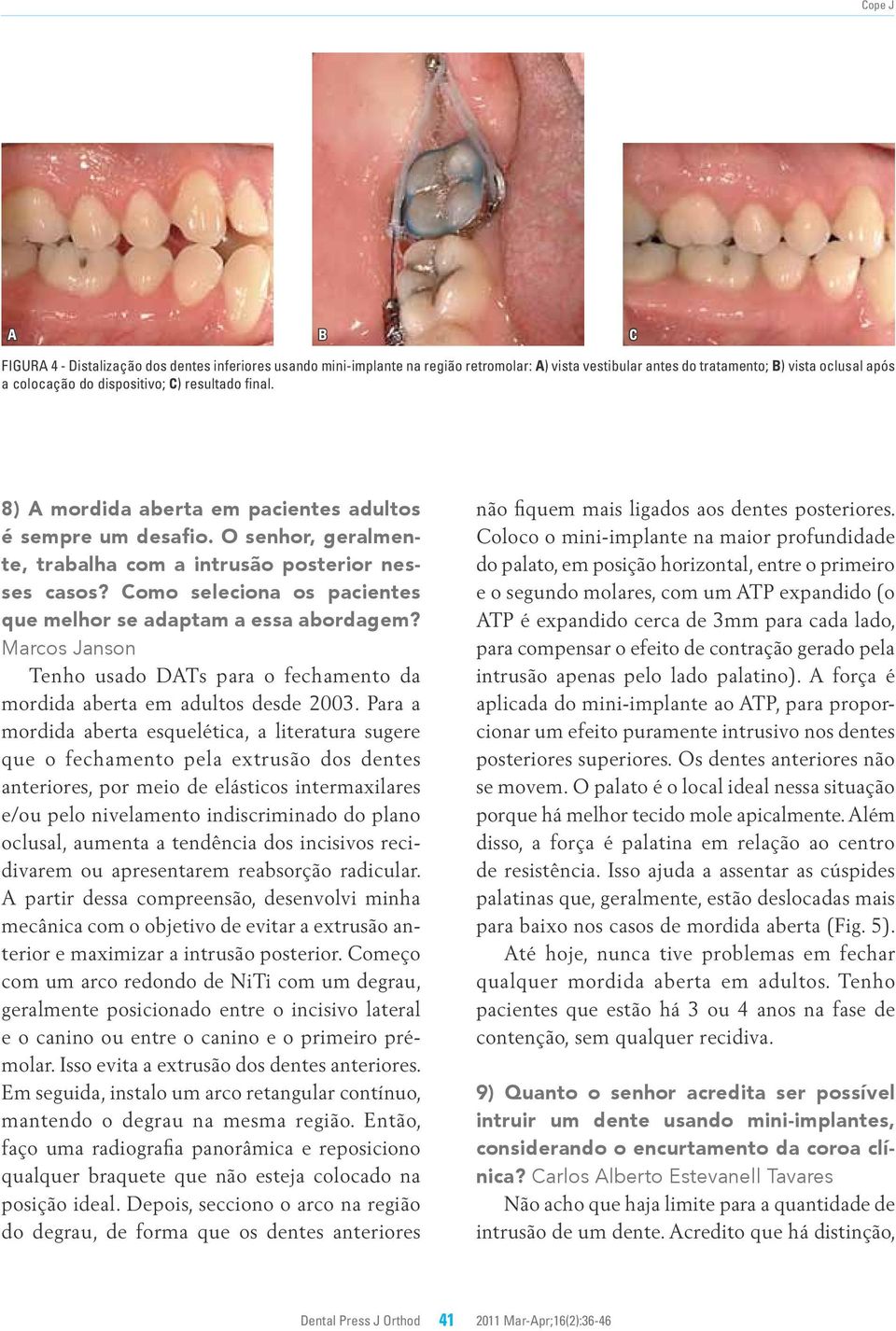 omo seleciona os pacientes que melhor se adaptam a essa abordagem? Marcos Janson Tenho usado DTs para o fechamento da mordida aberta em adultos desde 2003.