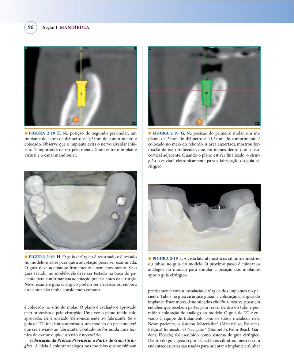 FIGURA 2-19 G, Na posição do primeiro molar, um implante de 5 mm de diâmetro e 11,5 mm de comprimento é colocado no meio do rebordo.