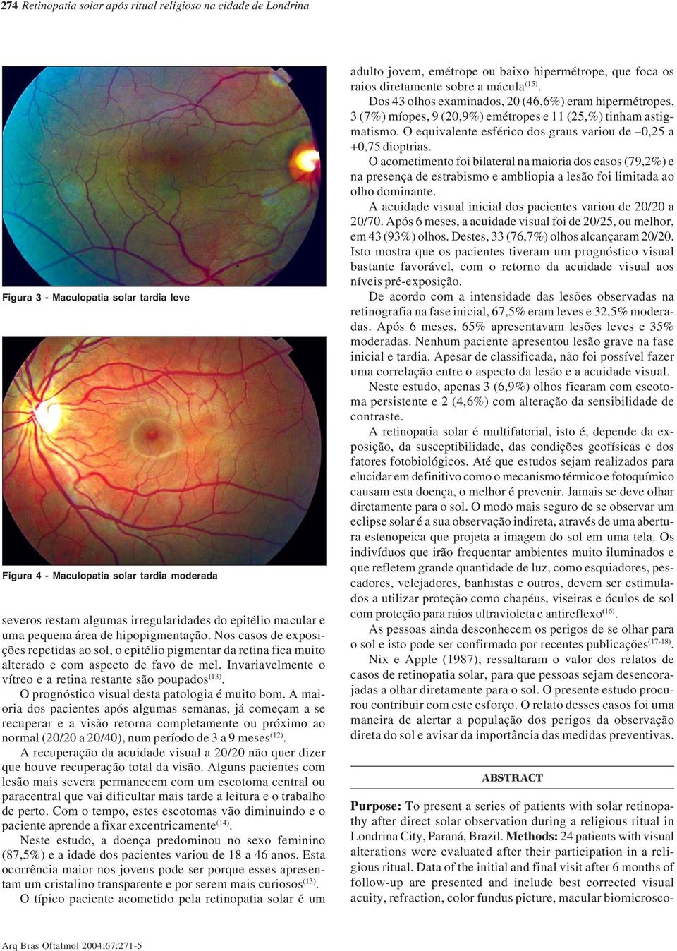 Invariavelmente o vítreo e a retina restante são poupados (13). O prognóstico visual desta patologia é muito bom.