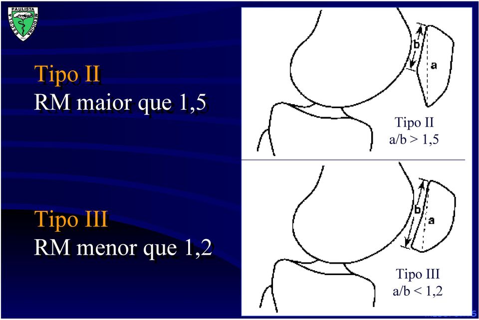 Tipo III RM menor que