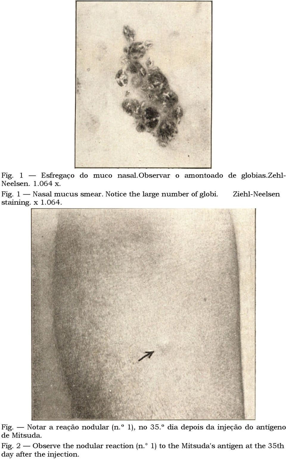 Notar a reação nodular (n.º 1), no 35.º dia depois da injeção do antígeno de Mitsuda. Fig.