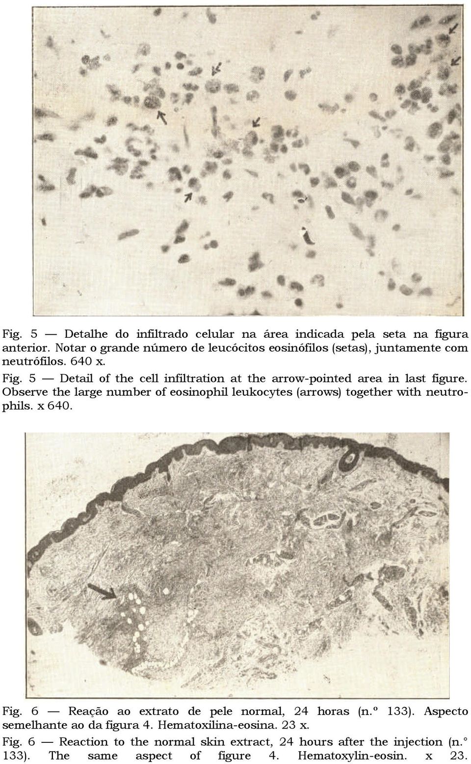 5 Detail of the cell infiltration at the arrow-pointed area in last figure.