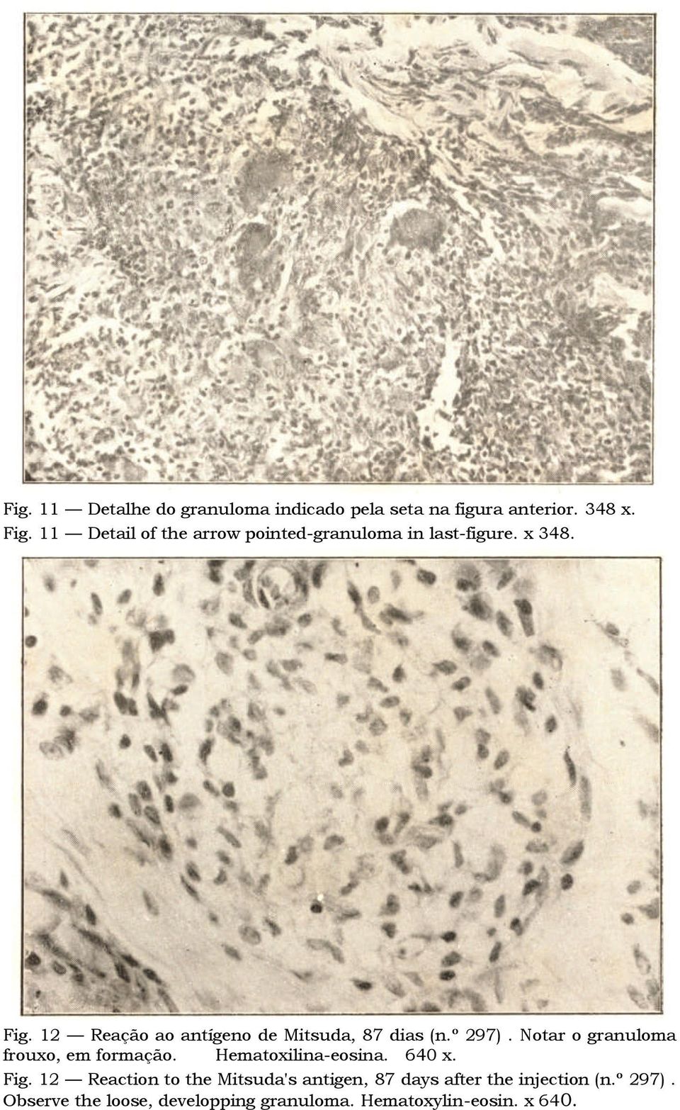 12 Reação ao antígeno de Mitsuda, 87 dias (n.º 297). Notar o granuloma frouxo, em formação.