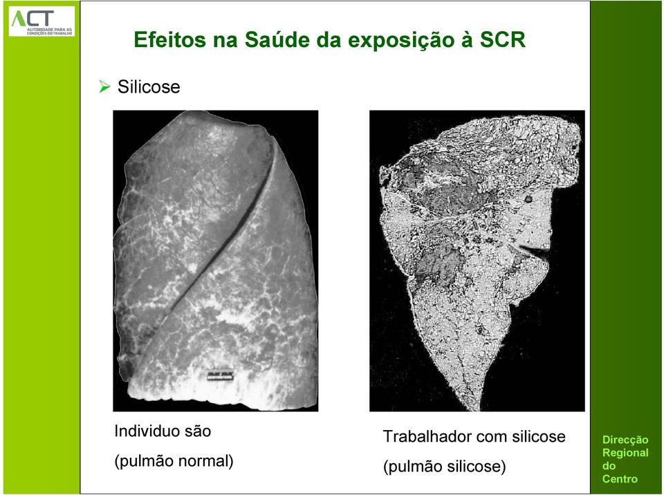 Individuo são (pulmão