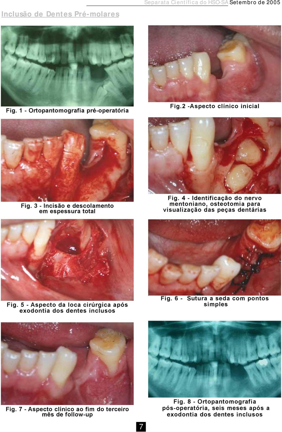 4 - Identificação do nervo mentoniano, osteotomia para visualização das peças dentárias Fig.