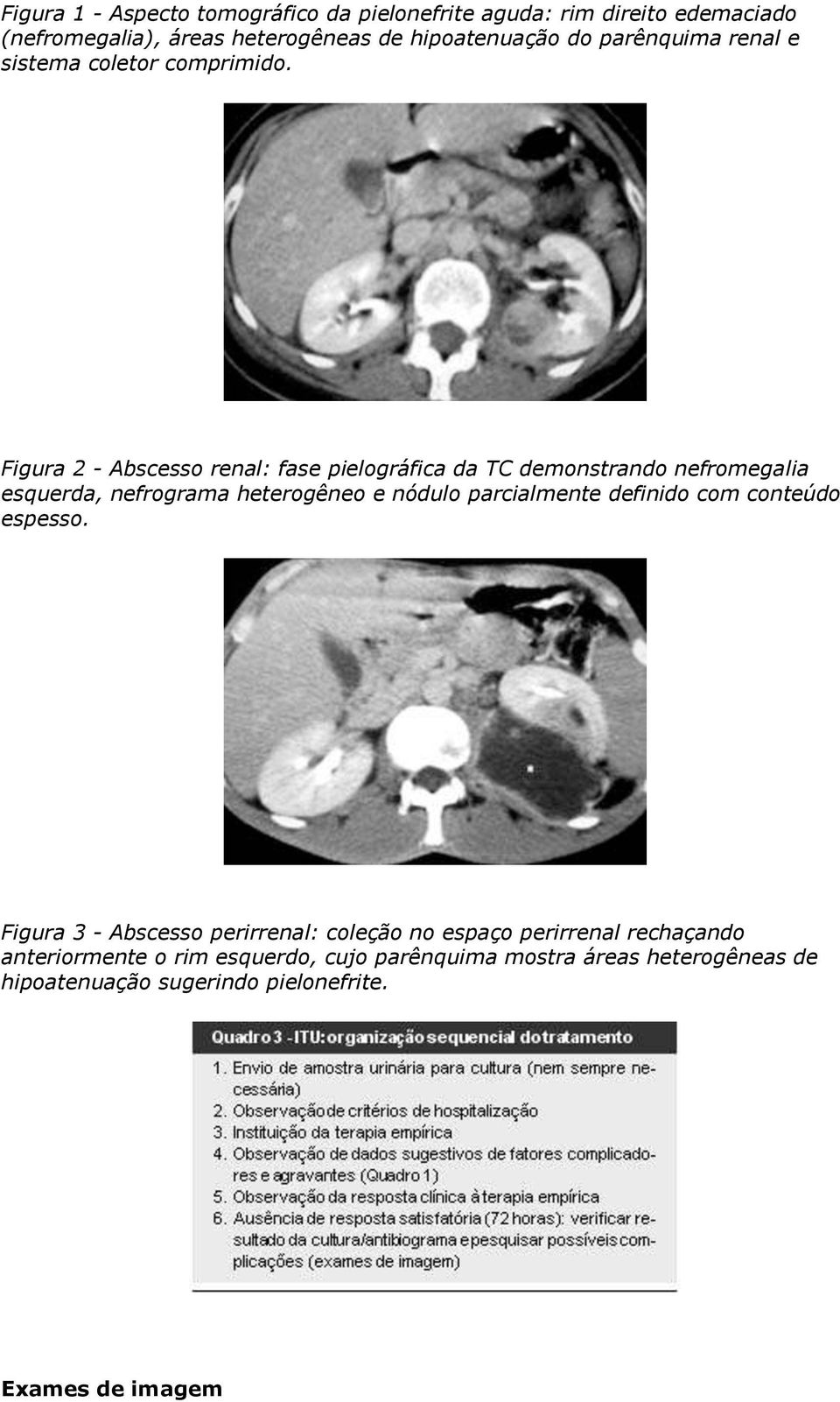 Figura 2 - Abscesso renal: fase pielográfica da TC demonstrando nefromegalia esquerda, nefrograma heterogêneo e nódulo parcialmente