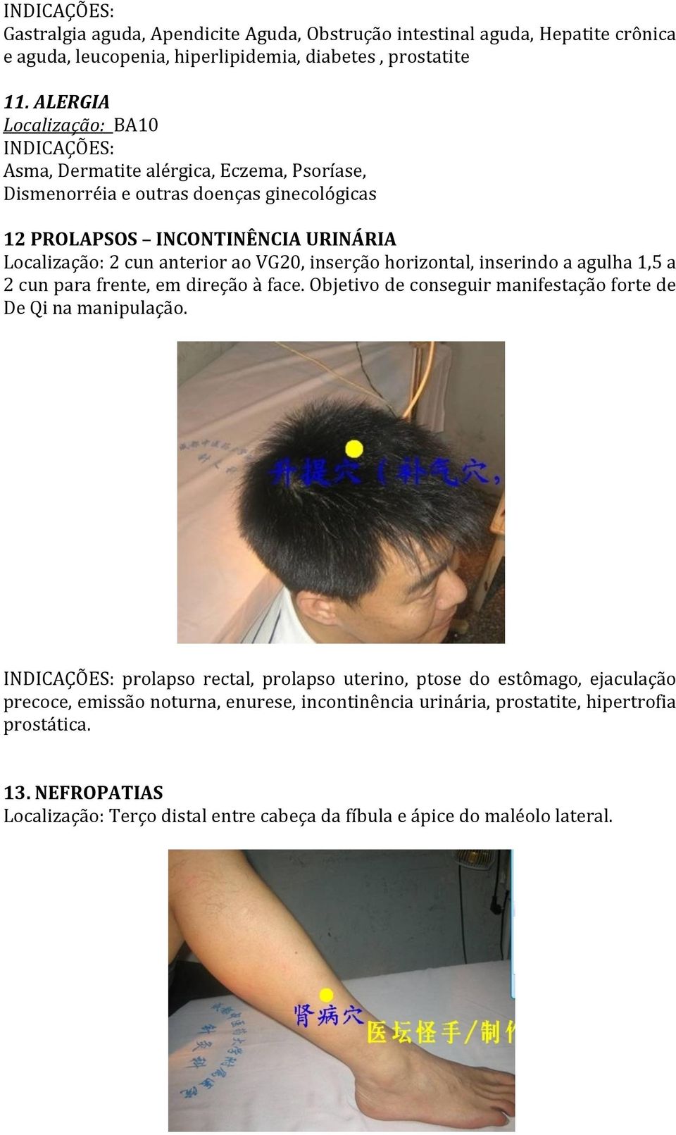 VG20, inserção horizontal, inserindo a agulha 1,5 a 2 cun para frente, em direção à face. Objetivo de conseguir manifestação forte de De Qi na manipulação.