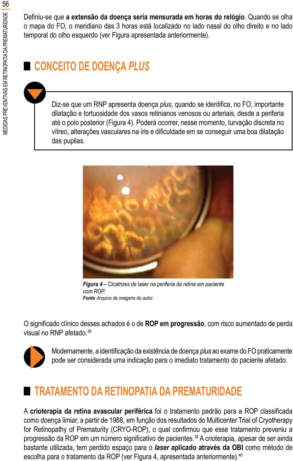 Poderá ocorrer, nesse momento, turvação discreta no das pupilas. Figura 4 Cicatrizes de laser na periferia da retina em paciente com ROP. Fonte: Arquivo de imagens do autor.