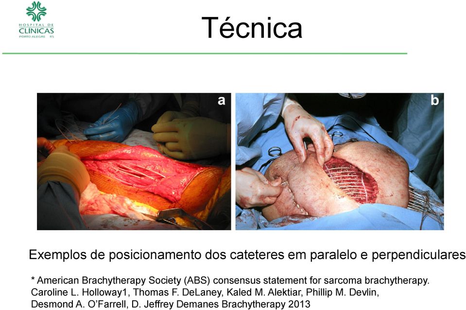 for sarcoma brachytherapy. Caroline L. Holloway1, Thomas F.