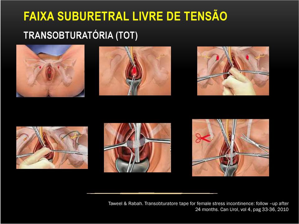 Transobturatore tape for female stress