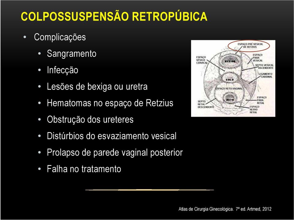 Distúrbios do esvaziamento vesical Prolapso de parede vaginal posterior