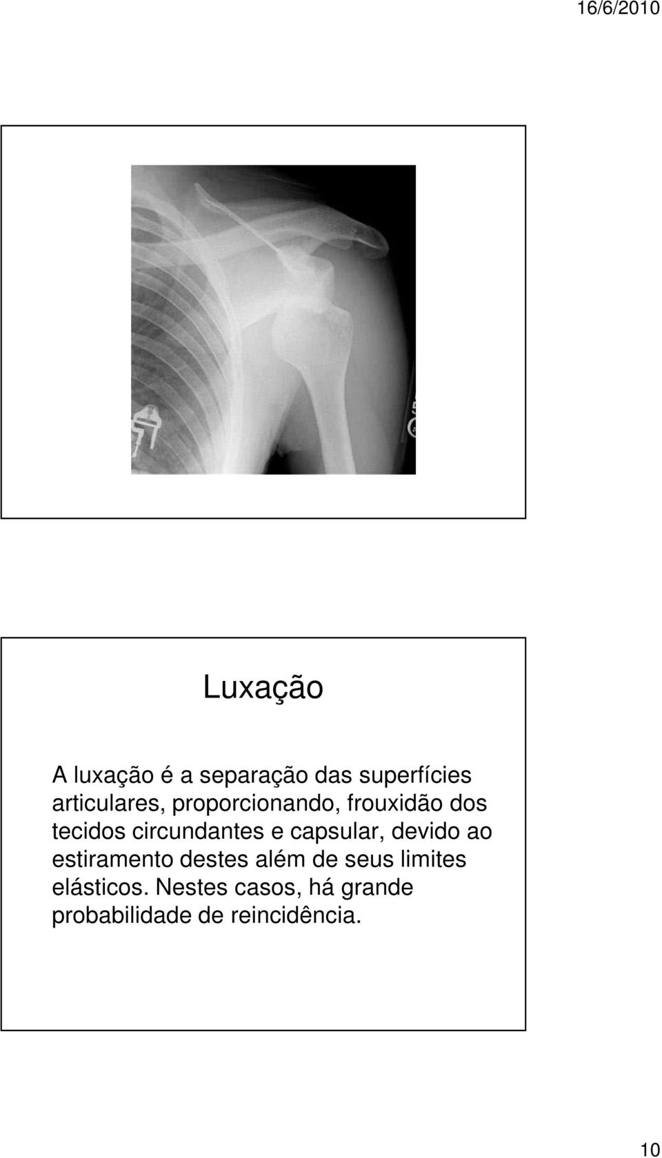 capsular, devido ao estiramento destes além de seus limites