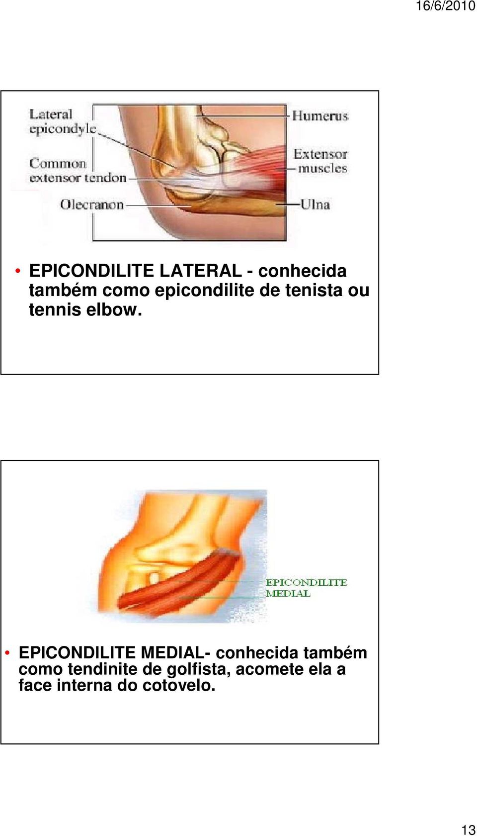 EPICONDILITE MEDIAL- conhecida também como