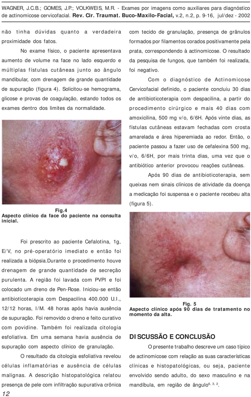 Solicitou-se hemograma, glicose e provas de coagulação, estando todos os exames dentro dos limites da normalidade. Fig.4 Aspecto clínico da face do paciente na consulta inicial.