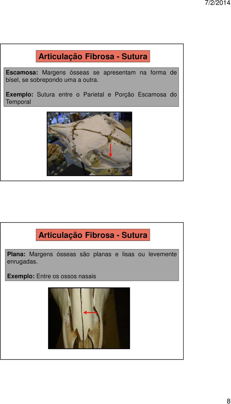 Exemplo: Sutura entre o Parietal e Porção Escamosa do Temporal Articulação