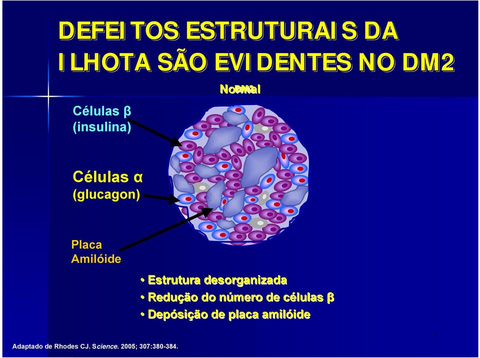 Estrutura desorganizada Redução do número de células β Depósição