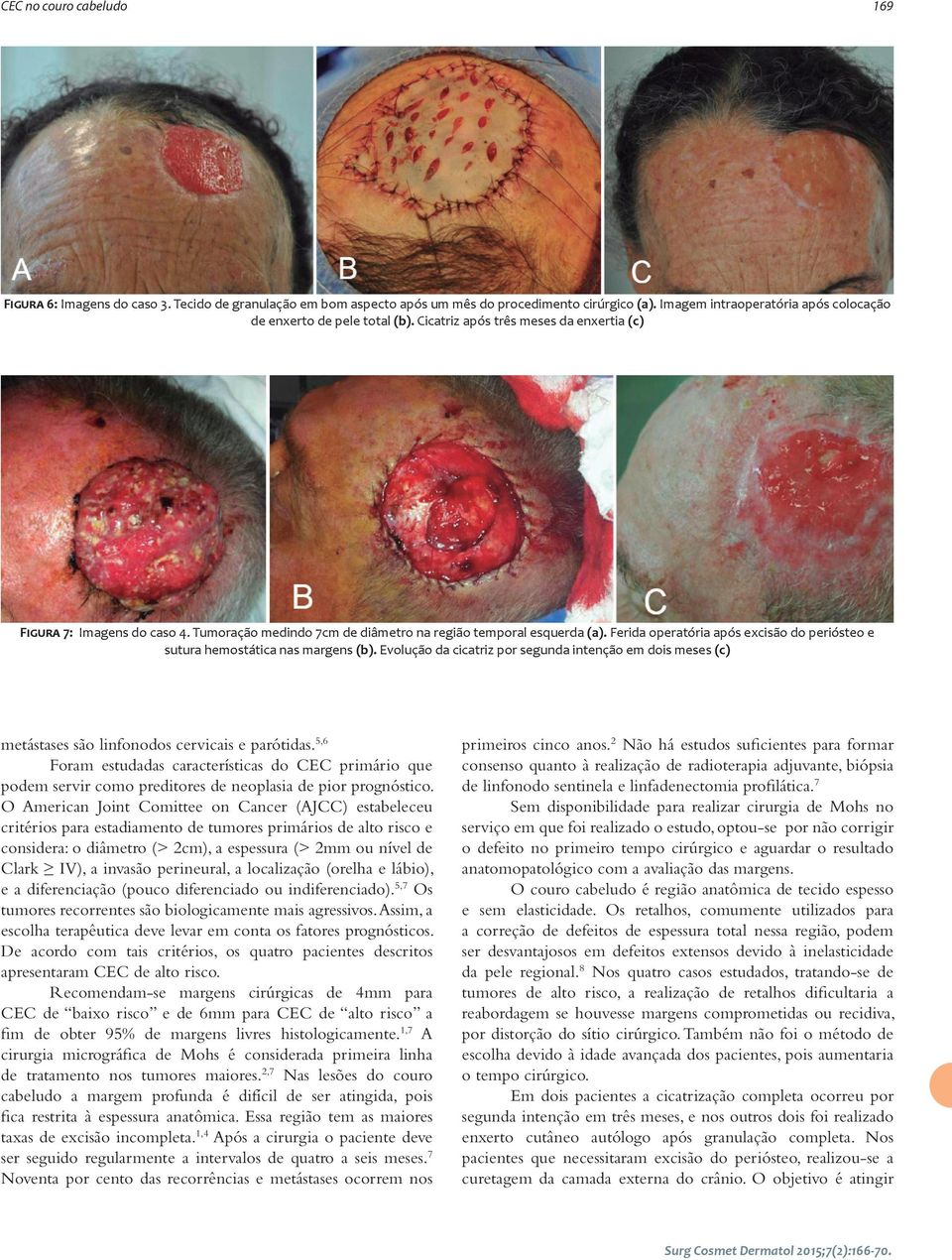 Ferida operatória após excisão do periósteo e sutura hemostática nas margens (b). Evolução da cicatriz por segunda intenção em dois meses (c) metástases são linfonodos cervicais e parótidas.