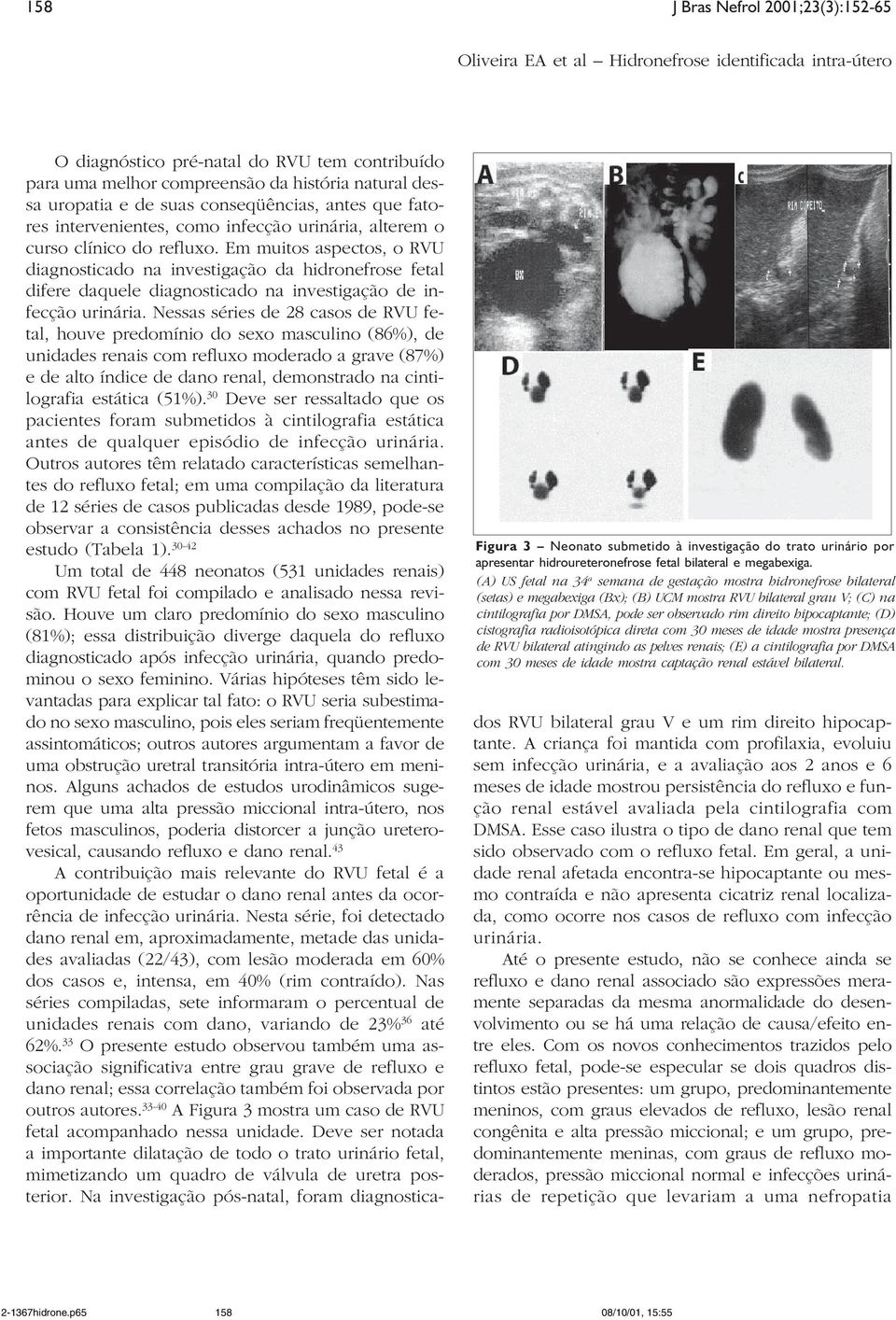 hipocaptante; (D) cistografia radioisotópica direta com 30 meses de idade mostra presença de RVU bilateral atingindo as pelves renais; (E) a cintilografia por DMSA com 30 meses de idade mostra