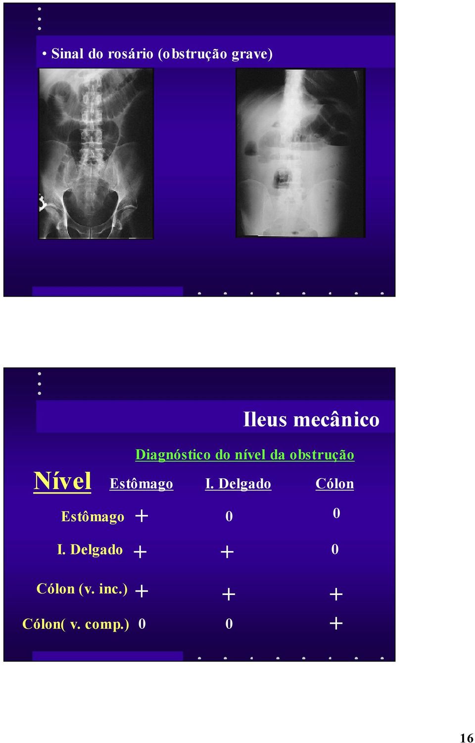 ) Ileus mecânico Diagnóstico do nível da