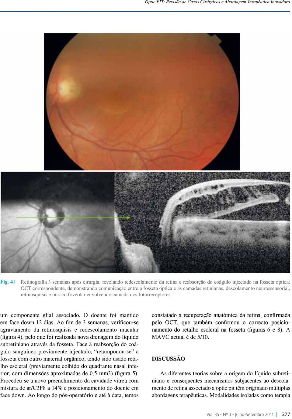 as camadas retinianas, descolamento neurossensorial, retinosquisis e buraco foveolar envolvendo camada dos fotorreceptores. um componente glial associado. O doente foi mantido em face down 12 dias.
