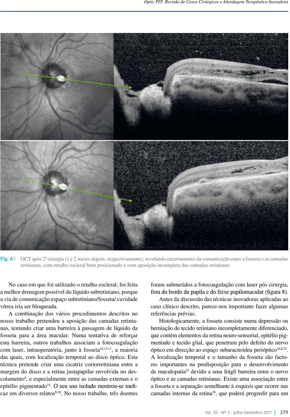 incompleta das camadas retinianas No caso em que foi utilizado o retalho escleral, foi feita a melhor drenagem possível do líquido subretiniano, porque a via de comunicação espaço