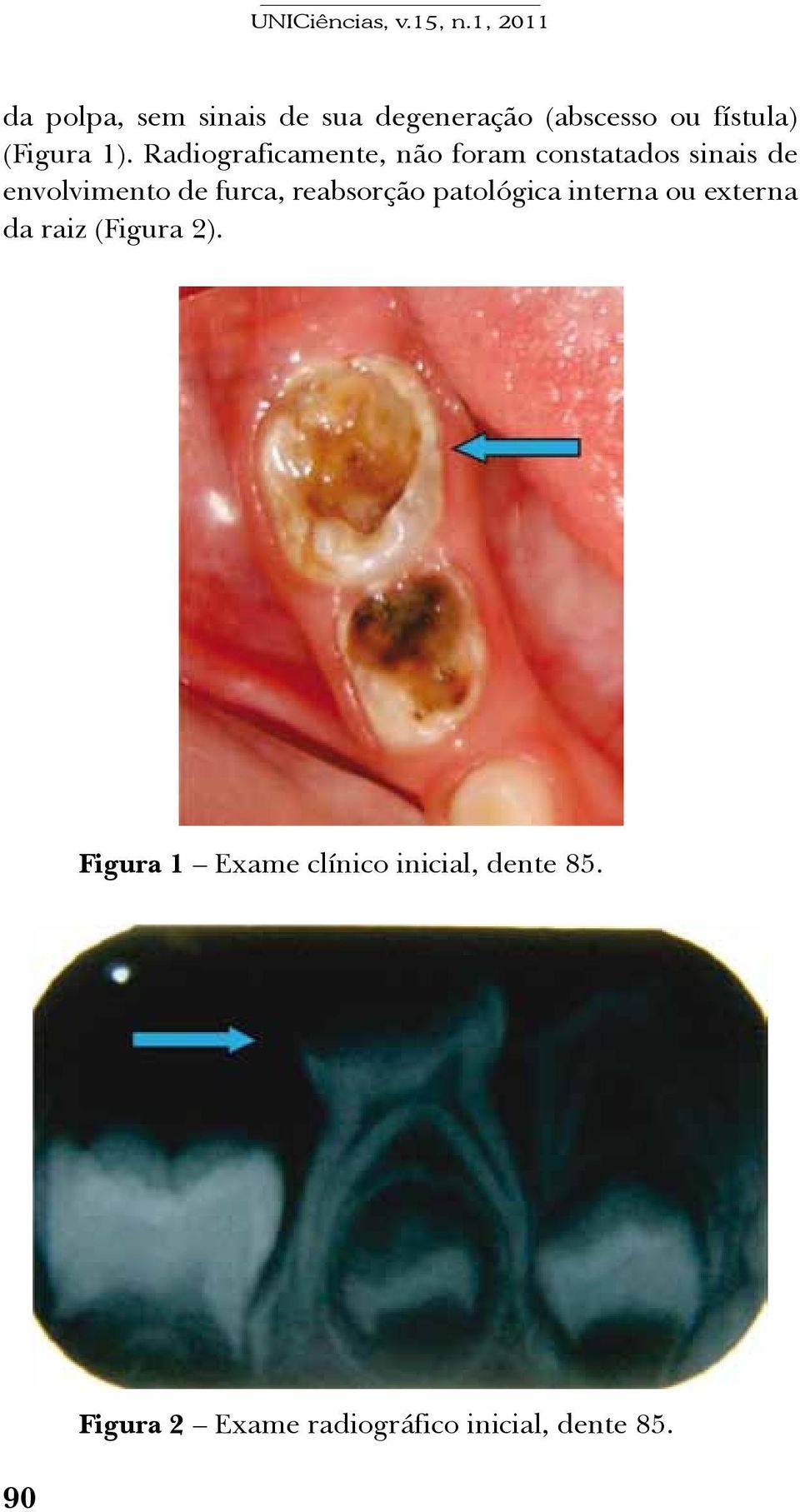 reabsorção patológica interna ou externa da raiz (Figura 2).