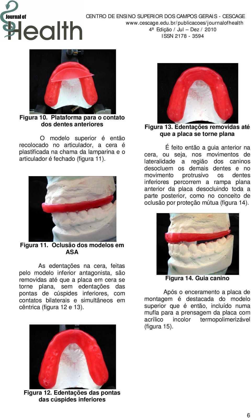 Edentações removidas até que a placa se torne plana É feito então a guia anterior na cera, ou seja, nos movimentos de lateralidade a região dos caninos desocluem os demais dentes e no movimento