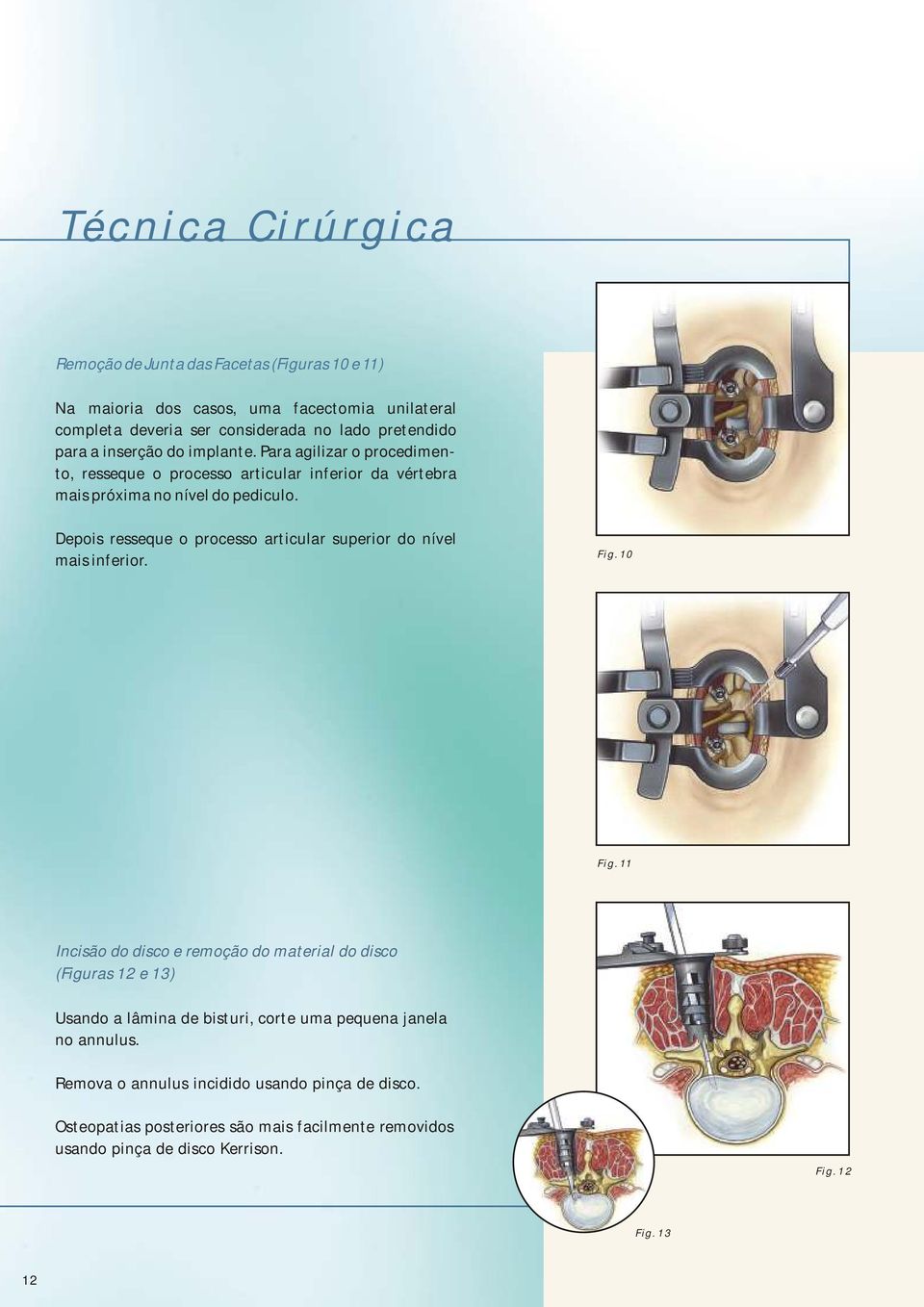 Depois resseque o processo articular superior do nível mais inferior. Fig. 10 Fig.