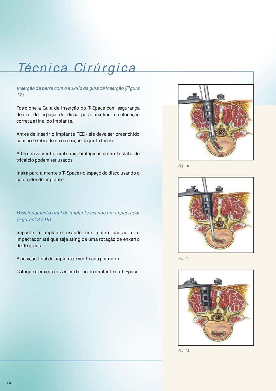 Alternativamente, materiais biológicos como fosfato de tricalcio podem ser usados. Insira parcialmente o T-Space no espaço do disco usando o colocador de implante. Fig.