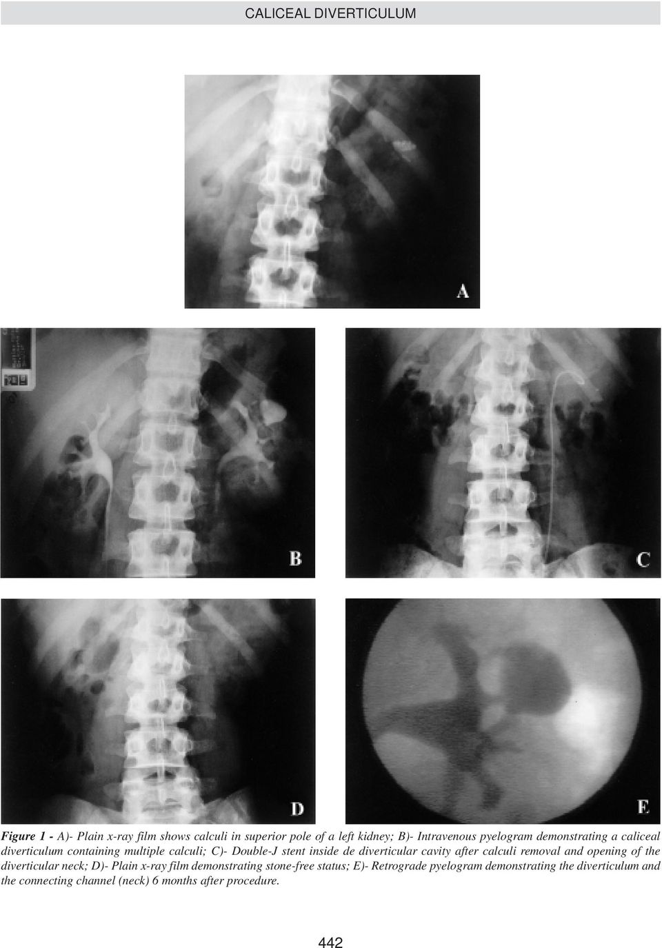 cavity after calculi removal and opening of the diverticular neck; D)- Plain x-ray film demonstrating stone-free