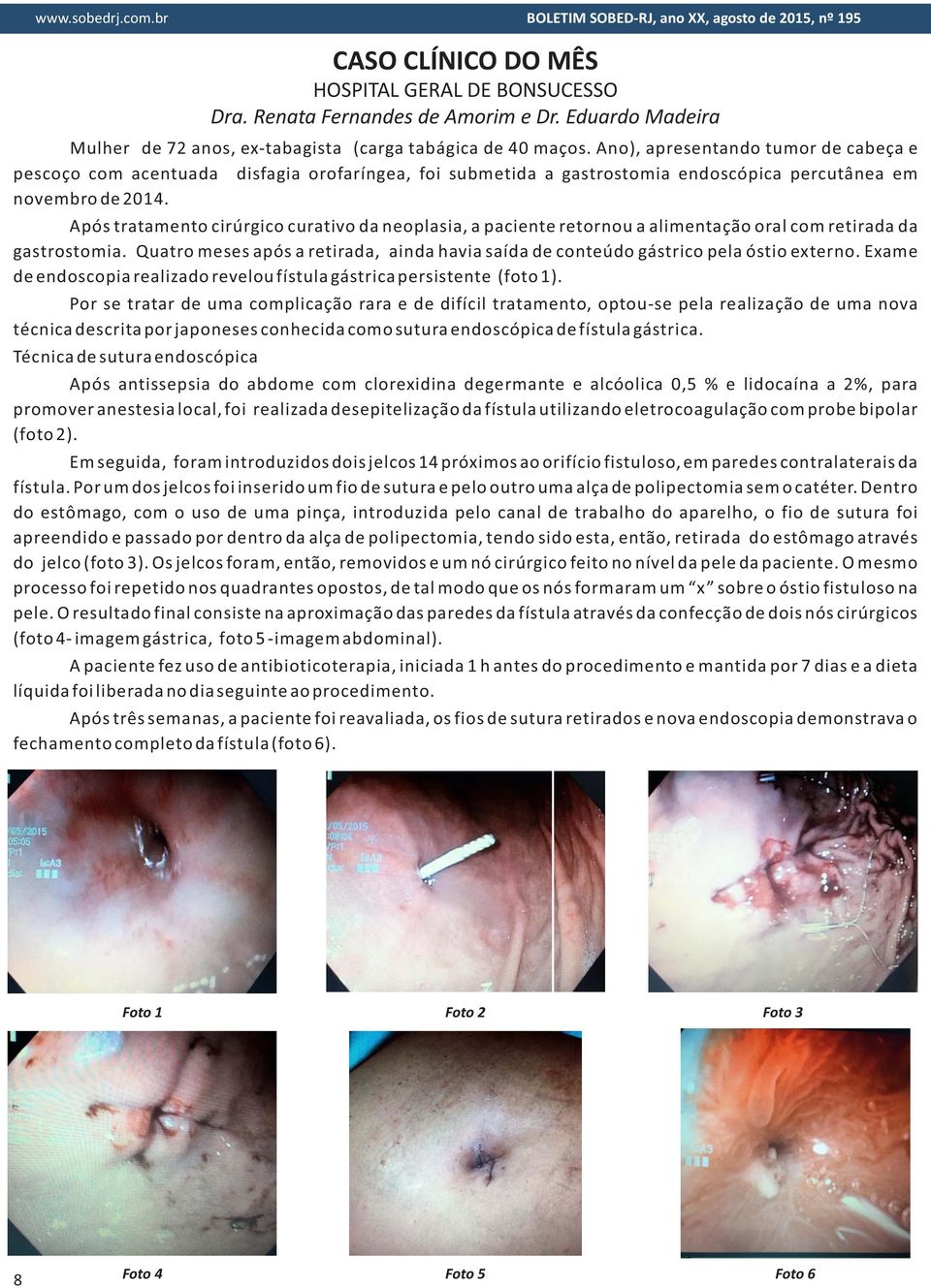 Após tratamento cirúrgico curativo da neoplasia, a paciente retornou a alimentação oral com retirada da gastrostomia.