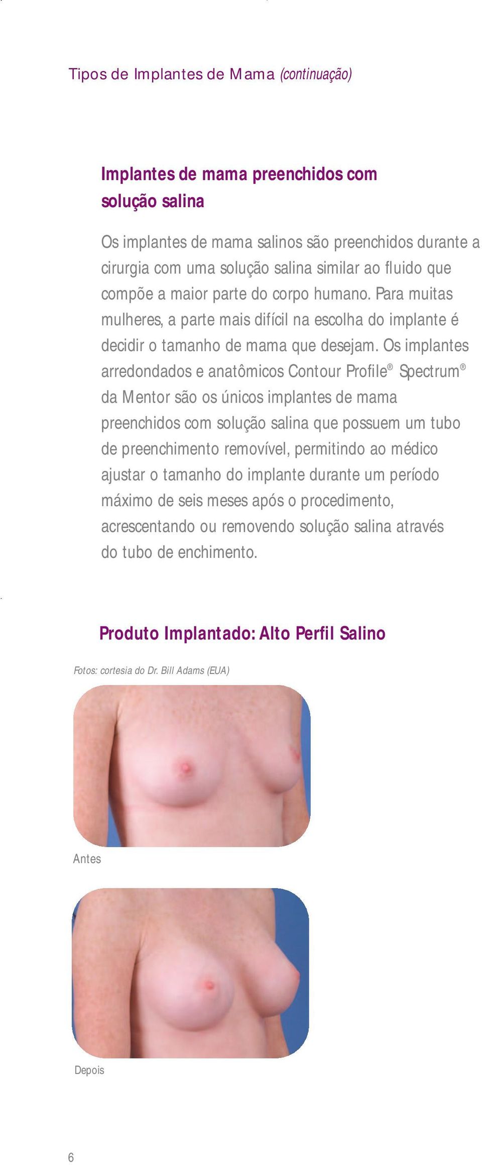 Os implantes arredondados e anatômicos Contour Profile Spectrum da Mentor são os únicos implantes de mama preenchidos com solução salina que possuem um tubo de preenchimento removível, permitindo ao