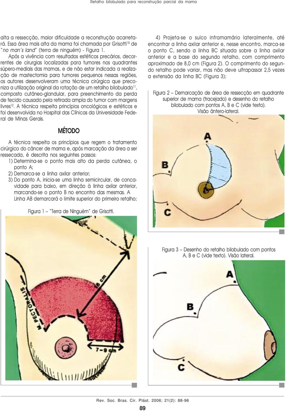 Após a vivência com resultados estéticos precários, decorrentes de cirurgias localizadas para tumores nos quadrantes súpero-mediais das mamas, e de não estar indicada a realização de mastectomia para