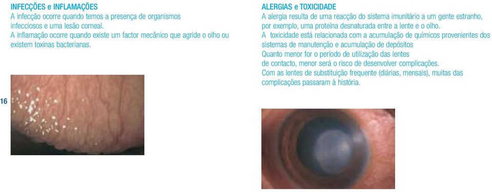 ALERGIAS e TOXICIDADE A alergia resulta de uma reacção do sistema imunitário a um gente estranho, por exemplo, uma proteína desnaturada entre a lente e o olho.