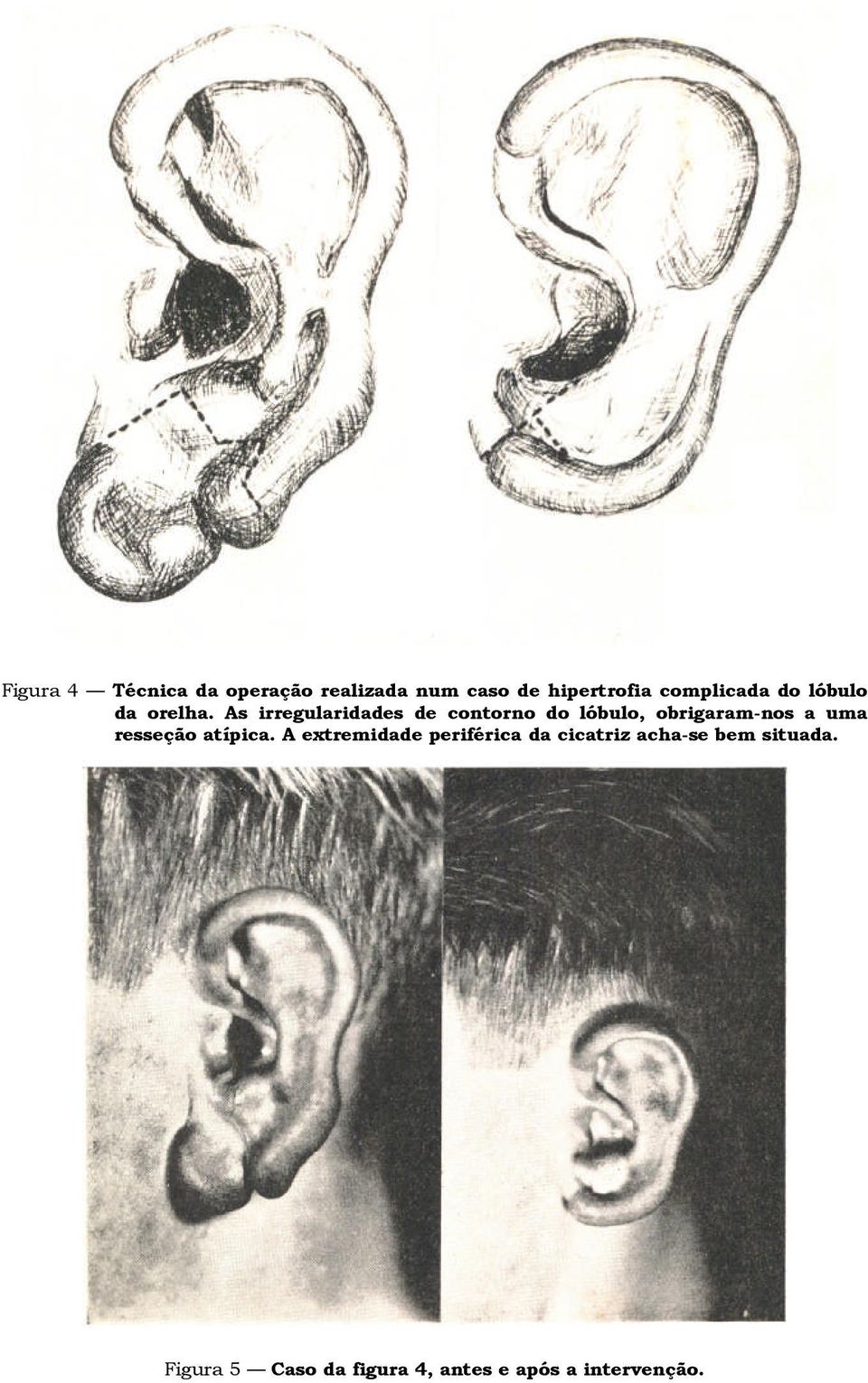 As irregularidades de contorno do lóbulo, obrigaram-nos a uma resseção