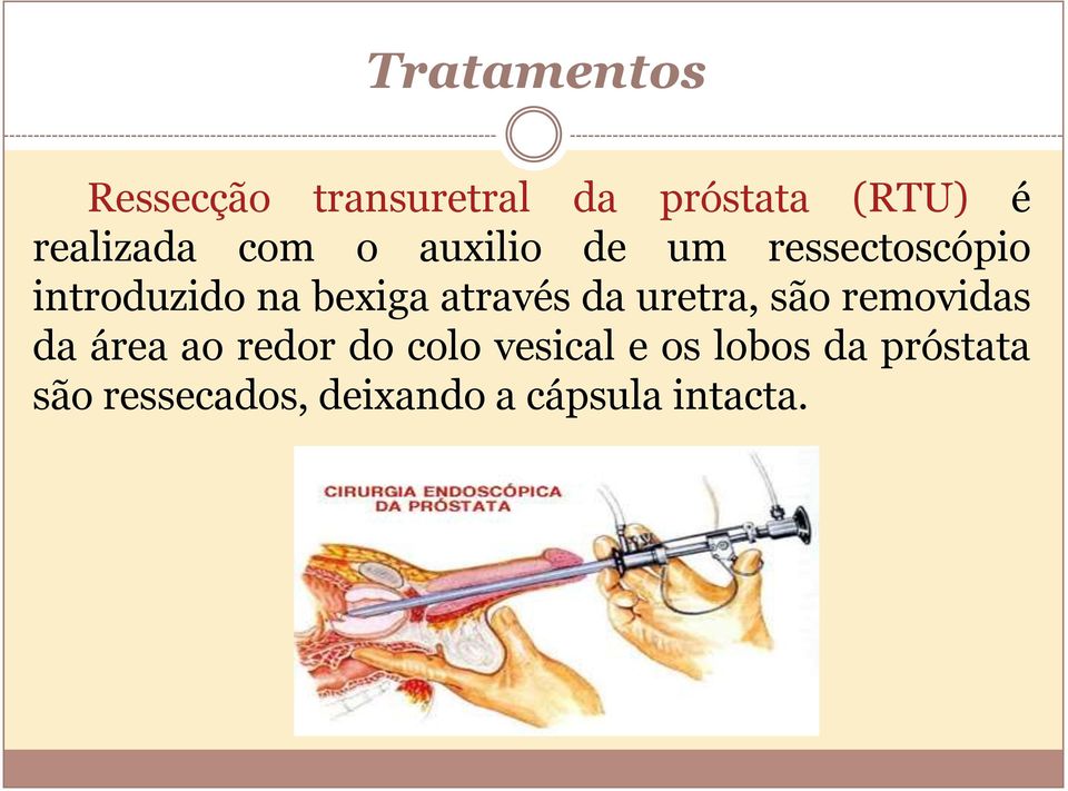 bexiga através da uretra, são removidas da área ao redor do