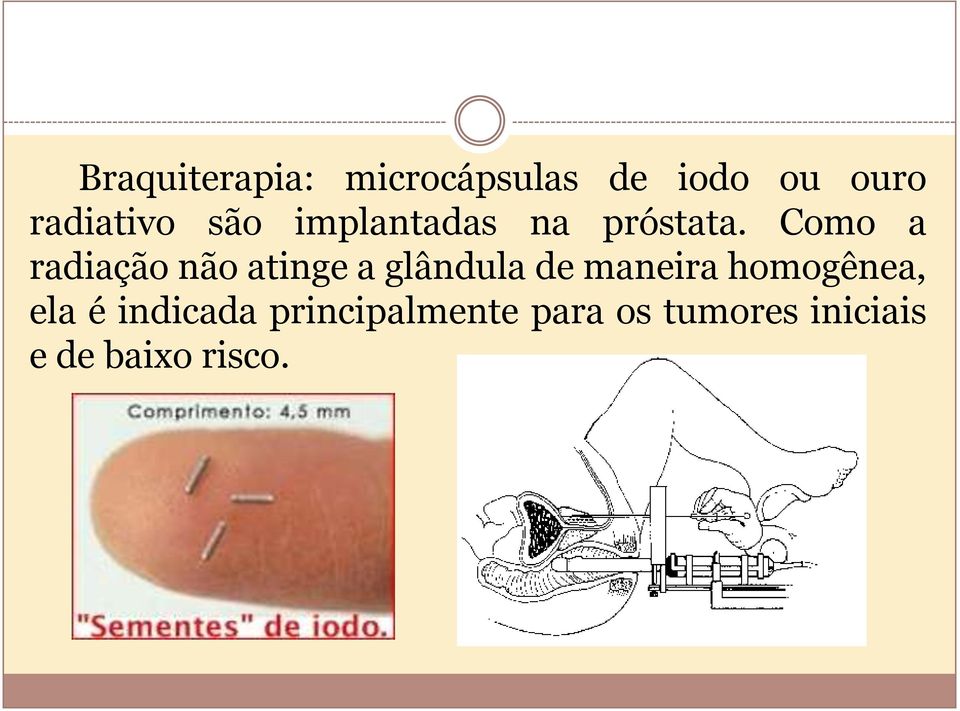 Como a radiação não atinge a glândula de maneira