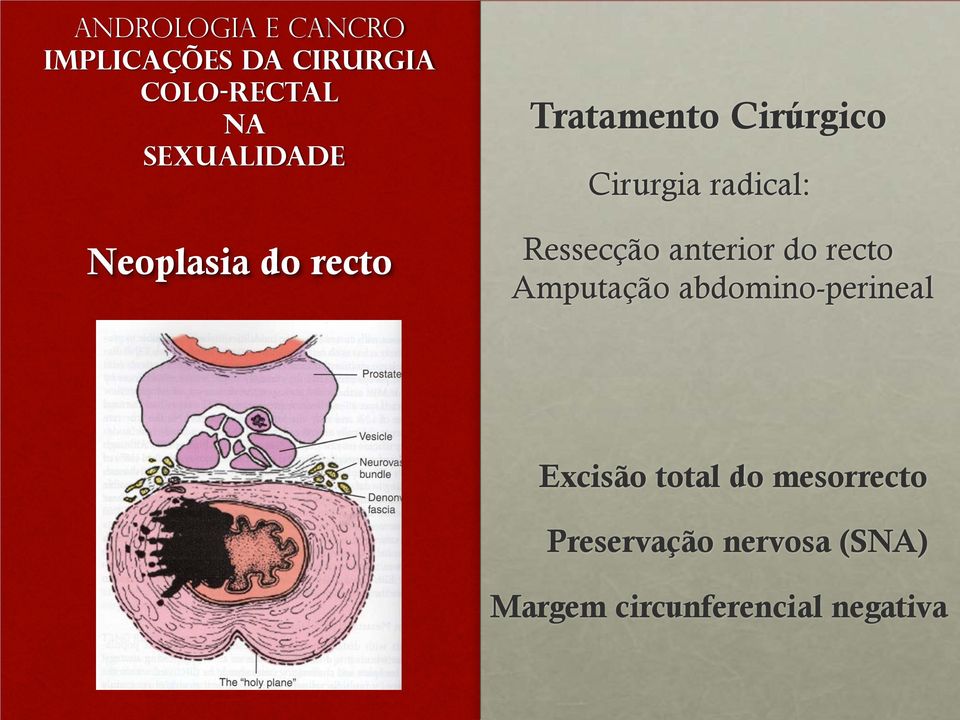 recto Amputação abdomino-perineal Excisão total do